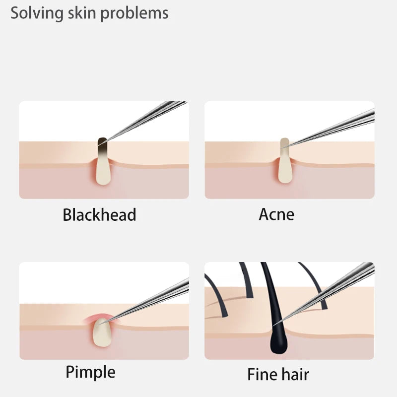 Acne Blackhead Removal Tool